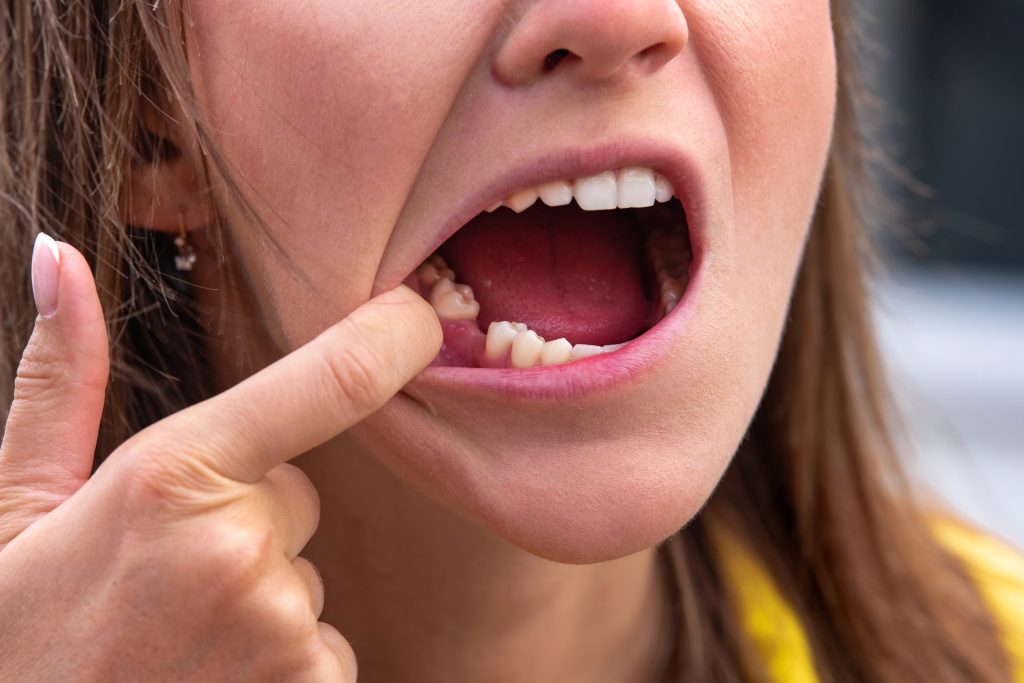 Young woman with missing tooth.